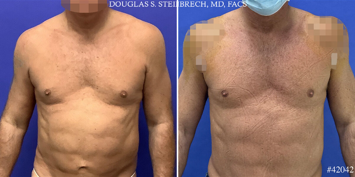 Alloclae Before and After Photos in CA, Beverly Hills, Patient 25499