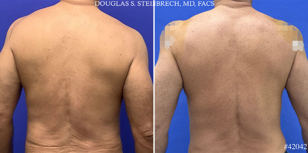 Alloclae Before and After Photos in CA, Beverly Hills, Patient 25499