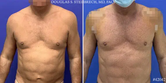 Alloclae Before and After Photos in CA, Beverly Hills, Patient 25499