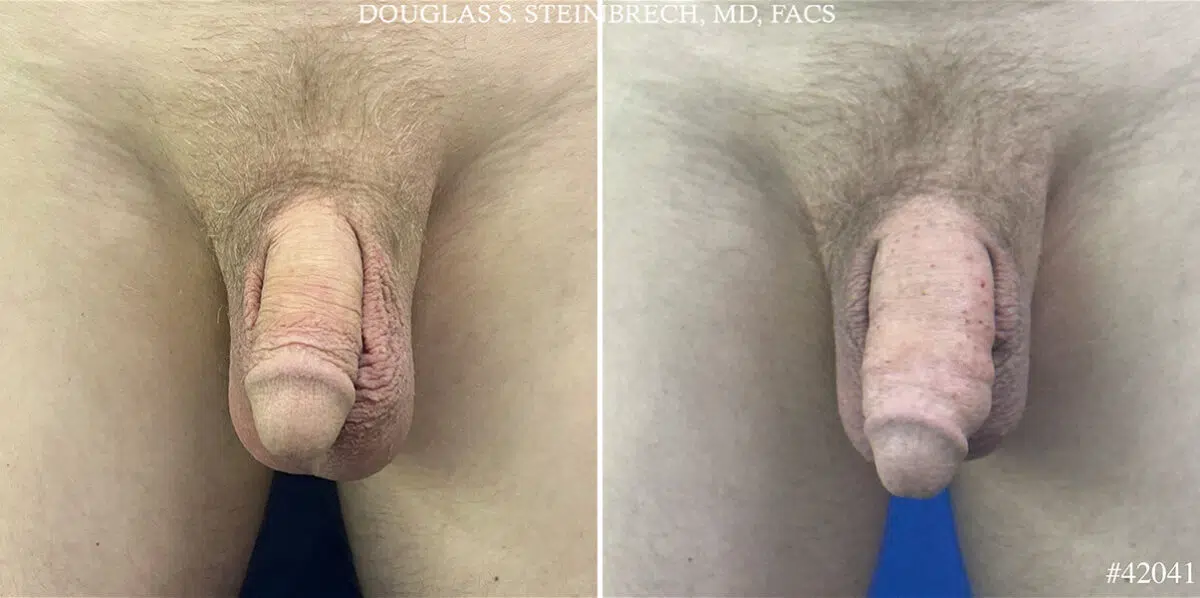 Male Enhancement Before and After Photos in CA, Beverly Hills, Patient 25531