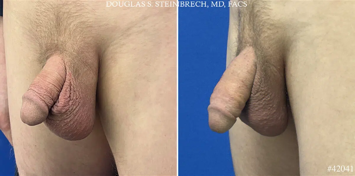 Male Enhancement Before and After Photos in CA, Beverly Hills, Patient 25531