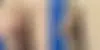 Male Enhancement Before and After Photos in CA, Beverly Hills, Patient 25531
