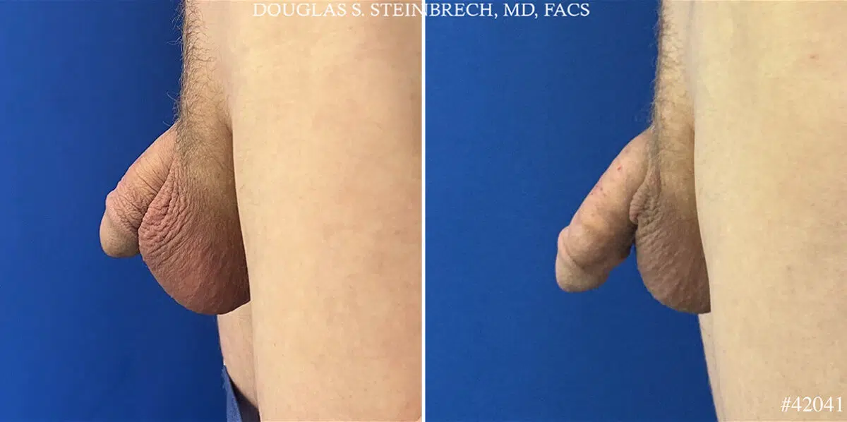 Male Enhancement Before and After Photos in CA, Beverly Hills, Patient 25531