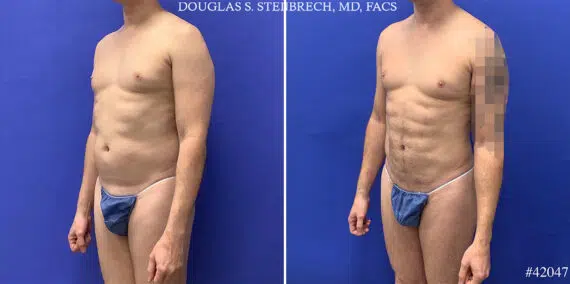 Body Banking Before and After Photos in CA, Beverly Hills, Patient 25550