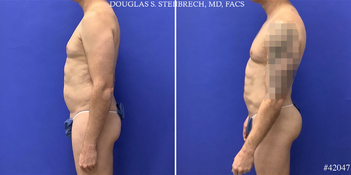 Body Banking Before and After Photos in CA, Beverly Hills, Patient 25550