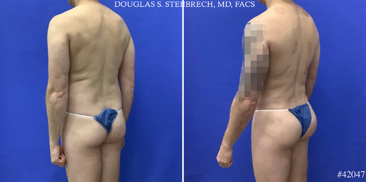 Body Banking Before and After Photos in CA, Beverly Hills, Patient 25550