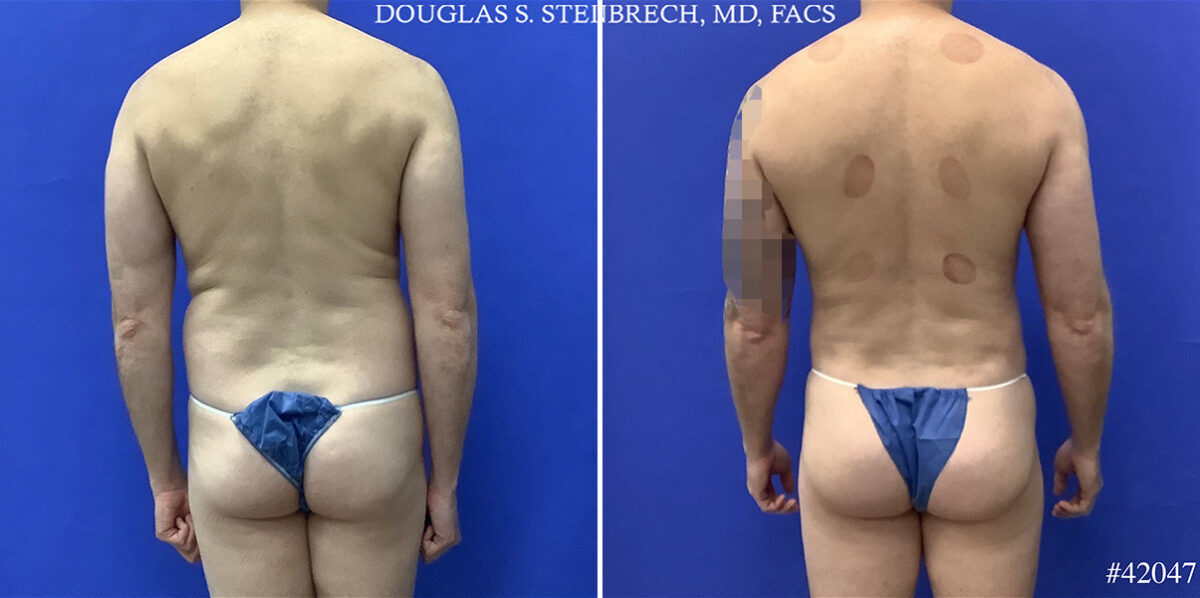 Body Banking Before and After Photos in CA, Beverly Hills, Patient 25550
