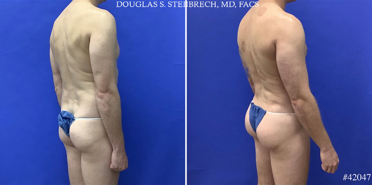 Body Banking Before and After Photos in CA, Beverly Hills, Patient 25550