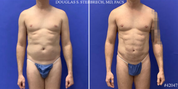 Body Banking Before and After Photos in CA, Beverly Hills, Patient 25550