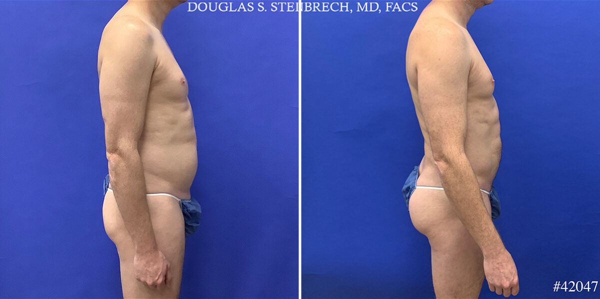 Body Banking Before and After Photos in CA, Beverly Hills, Patient 25550