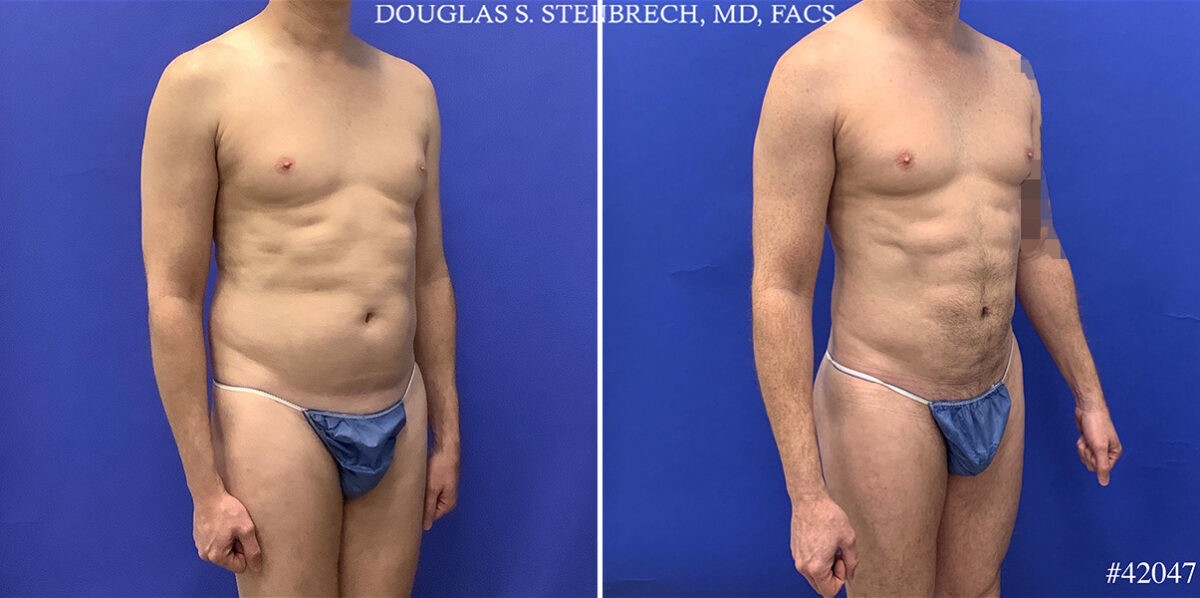Body Banking Before and After Photos in CA, Beverly Hills, Patient 25550