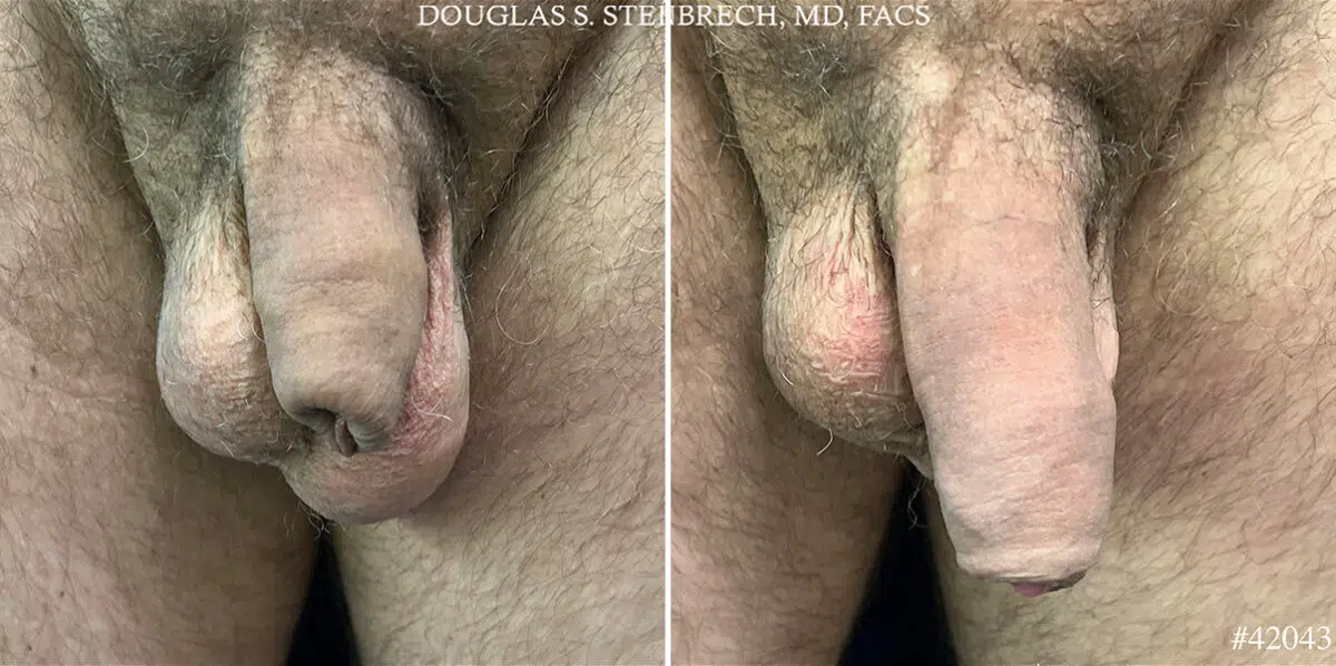 Male Enhancement Before and After Photos in CA, Beverly Hills, Patient 25575