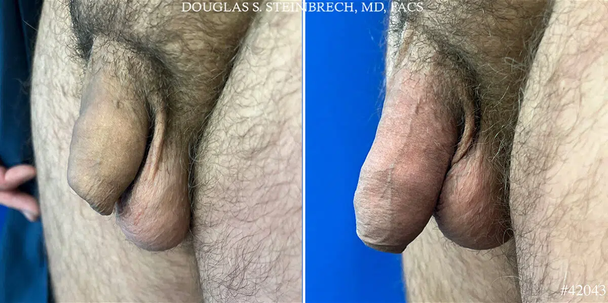 Male Enhancement Before and After Photos in CA, Beverly Hills, Patient 25575