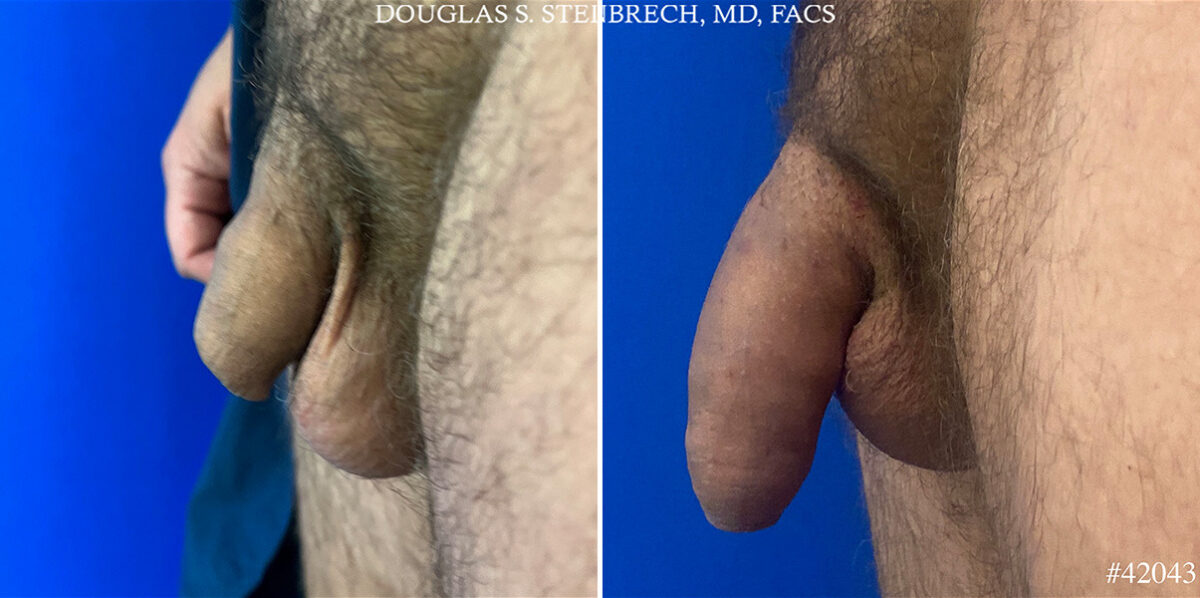 Male Enhancement Before and After Photos in CA, Beverly Hills, Patient 25575