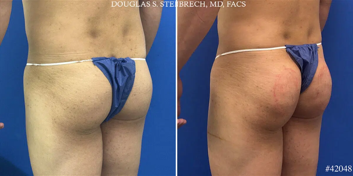 Alloclae Before and After Photos in CA, Beverly Hills, Patient 25668