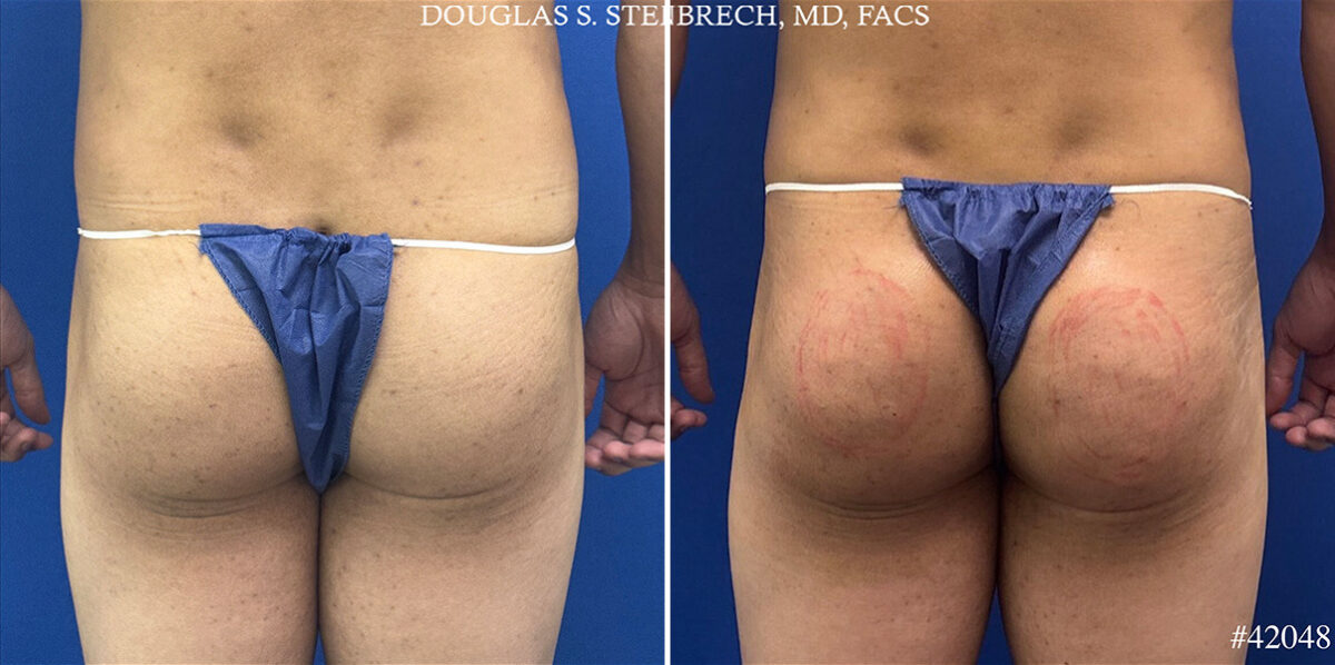 Alloclae Before and After Photos in CA, Beverly Hills, Patient 25668