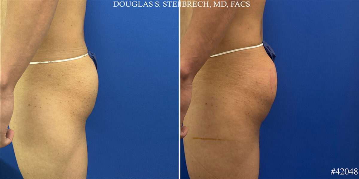 Alloclae Before and After Photos in CA, Beverly Hills, Patient 25668