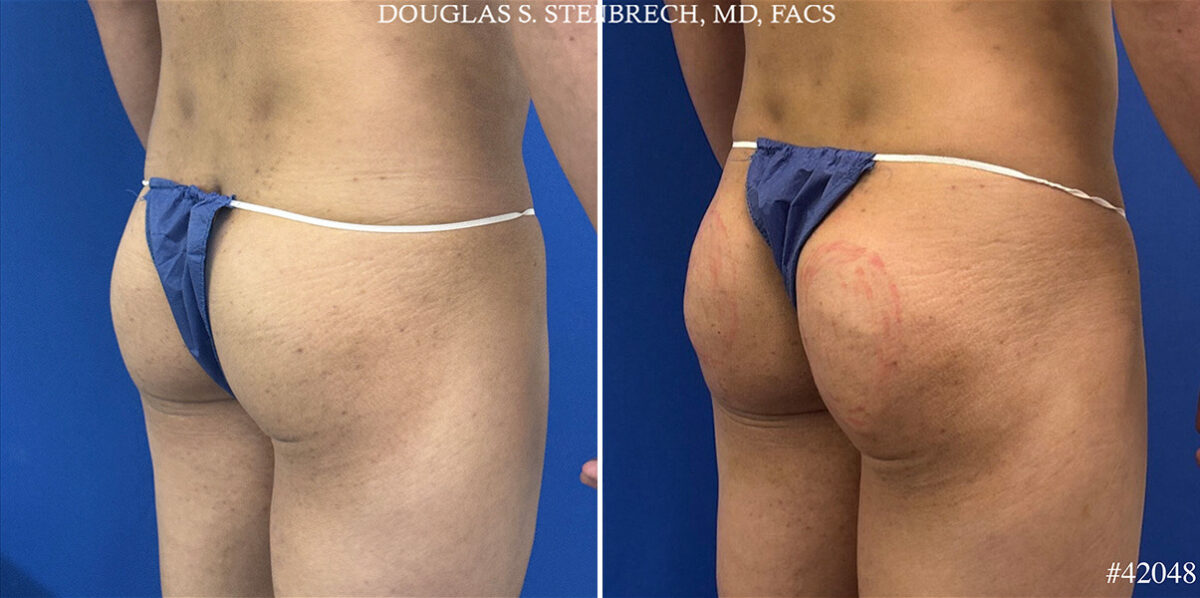 Alloclae Before and After Photos in CA, Beverly Hills, Patient 25668