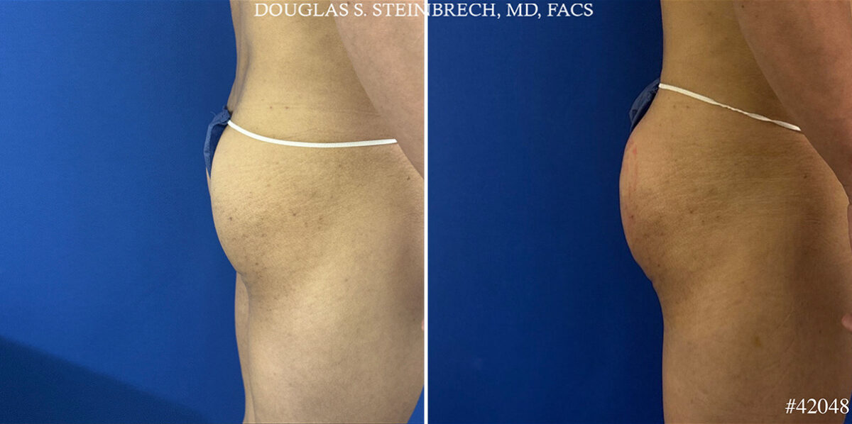 Alloclae Before and After Photos in CA, Beverly Hills, Patient 25668
