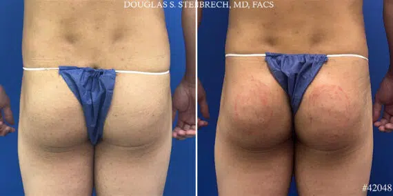 Alloclae Before and After Photos in CA, Beverly Hills, Patient 25668