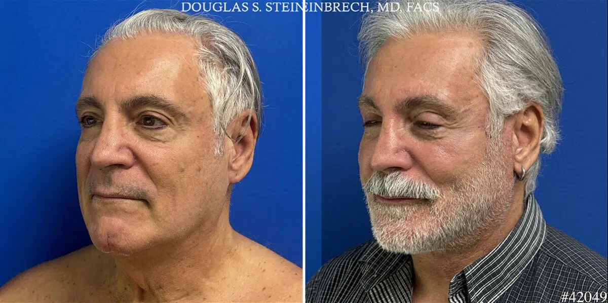 Facelift Before and After Photos in CA, Beverly Hills, Patient 25687