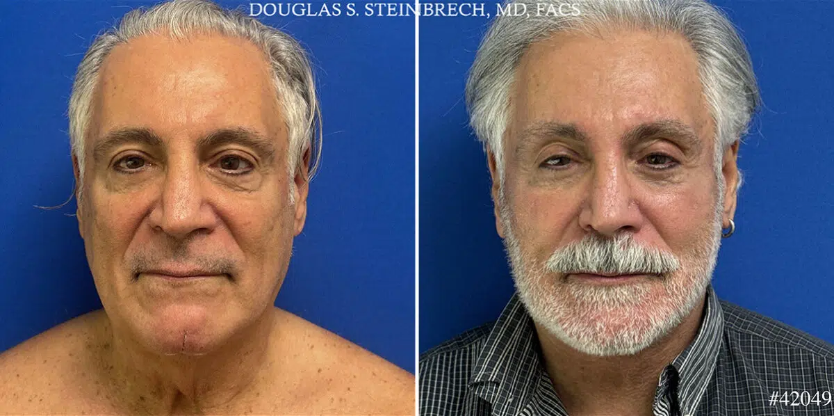Facelift Before and After Photos in CA, Beverly Hills, Patient 25687