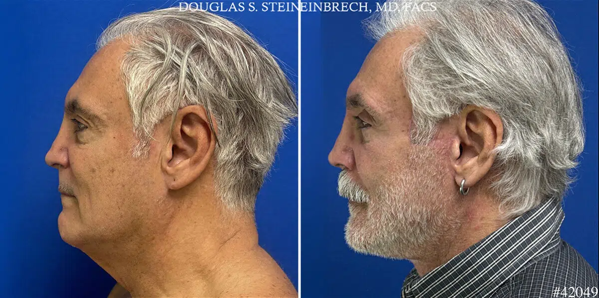 Facelift Before and After Photos in CA, Beverly Hills, Patient 25687