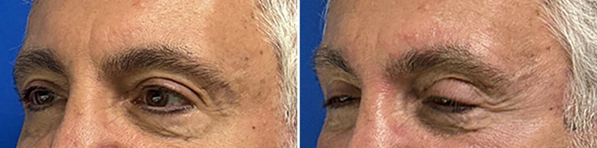 Eyelid Surgery Before and After Photos in CA, Beverly Hills, Patient 25703