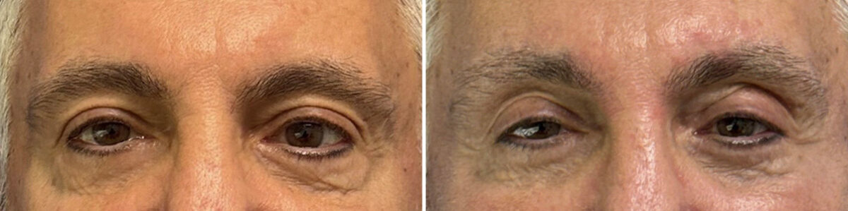 Eyelid Surgery Before and After Photos in CA, Beverly Hills, Patient 25703