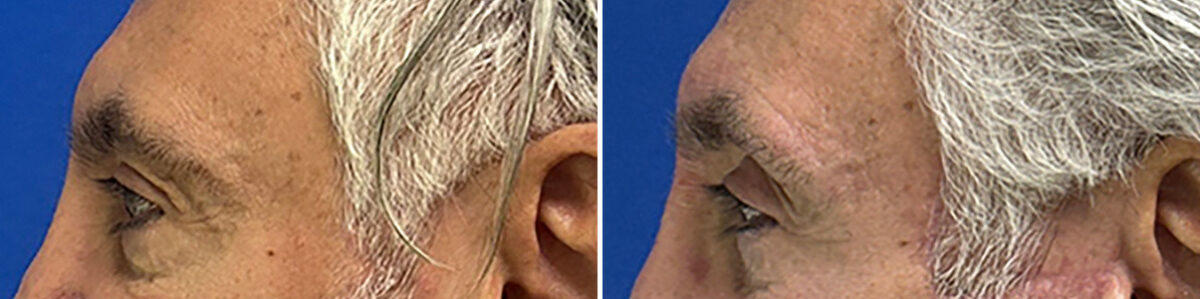 Eyelid Surgery Before and After Photos in CA, Beverly Hills, Patient 25703