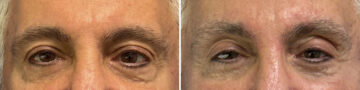 Eyelid Surgery Before and After Photos in CA, Beverly Hills, Patient 25703