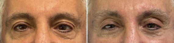 Eyelid Surgery Before and After Photos in CA, Beverly Hills, Patient 25703