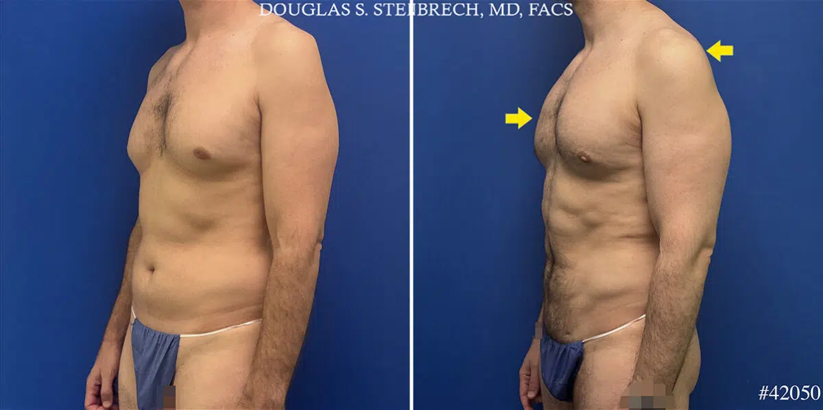 Body Banking Before and After Photos in CA, Beverly Hills, Patient 25720
