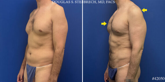 Body Banking Before and After Photos in CA, Beverly Hills, Patient 25720