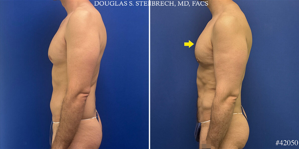 Body Banking Before and After Photos in CA, Beverly Hills, Patient 25720