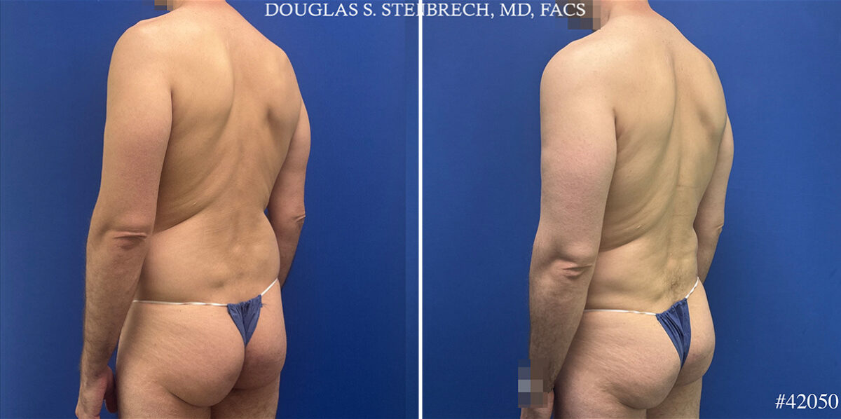 Body Banking Before and After Photos in CA, Beverly Hills, Patient 25720