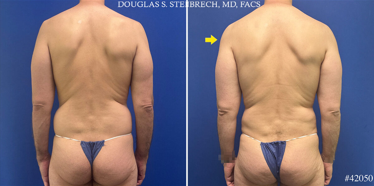 Body Banking Before and After Photos in CA, Beverly Hills, Patient 25720