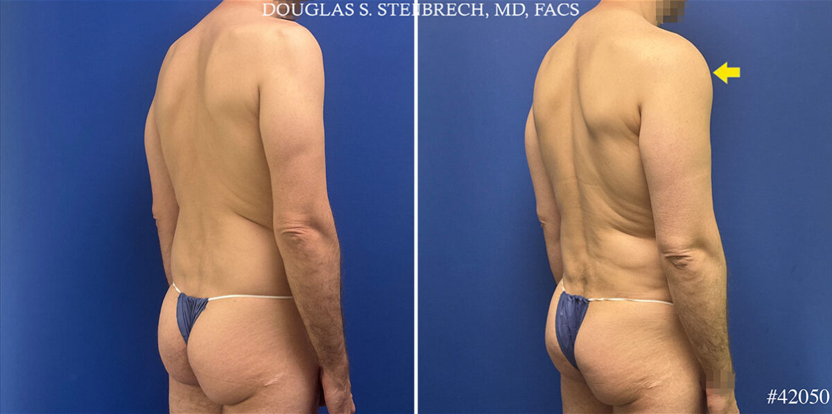 Body Banking Before and After Photos in CA, Beverly Hills, Patient 25720