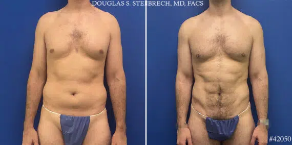 Body Banking Before and After Photos in CA, Beverly Hills, Patient 25720