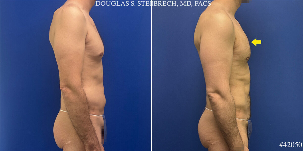 Body Banking Before and After Photos in CA, Beverly Hills, Patient 25720