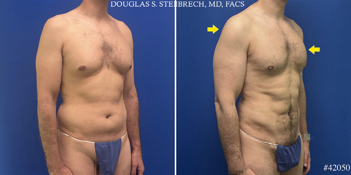 Body Banking Before and After Photos in CA, Beverly Hills, Patient 25720
