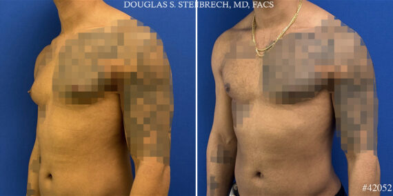 Gynecomastia Before and After Photos in CA, Beverly Hills, Patient 25745