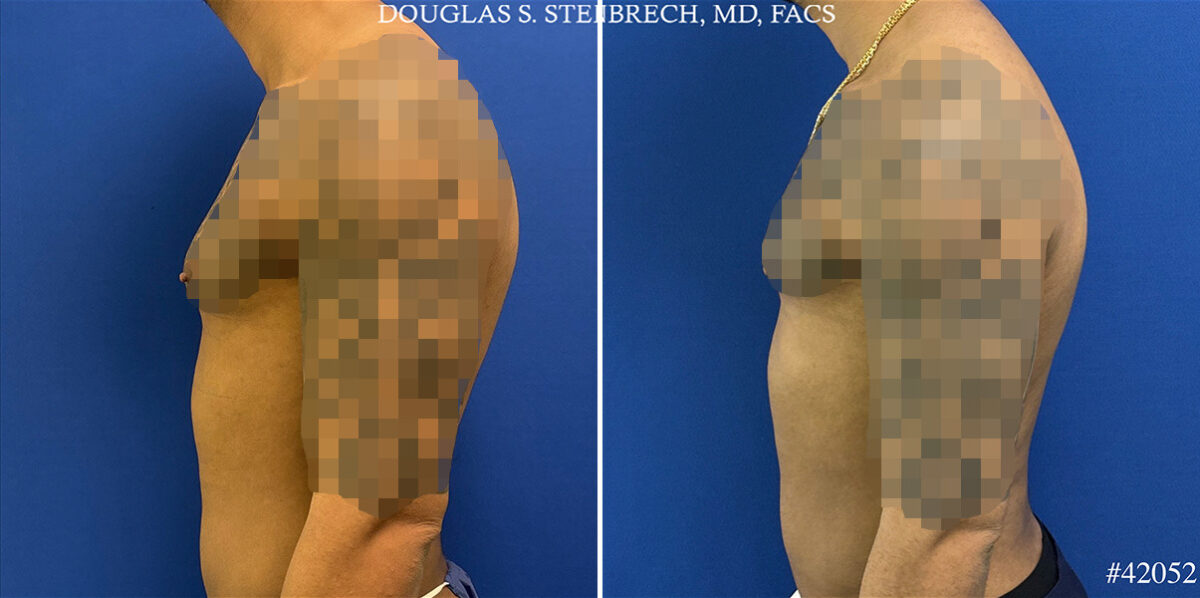Gynecomastia Before and After Photos in CA, Beverly Hills, Patient 25745