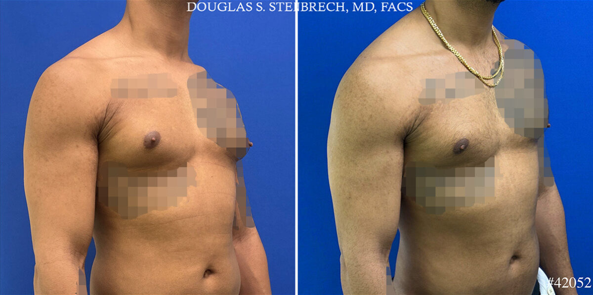 Gynecomastia Before and After Photos in CA, Beverly Hills, Patient 25745