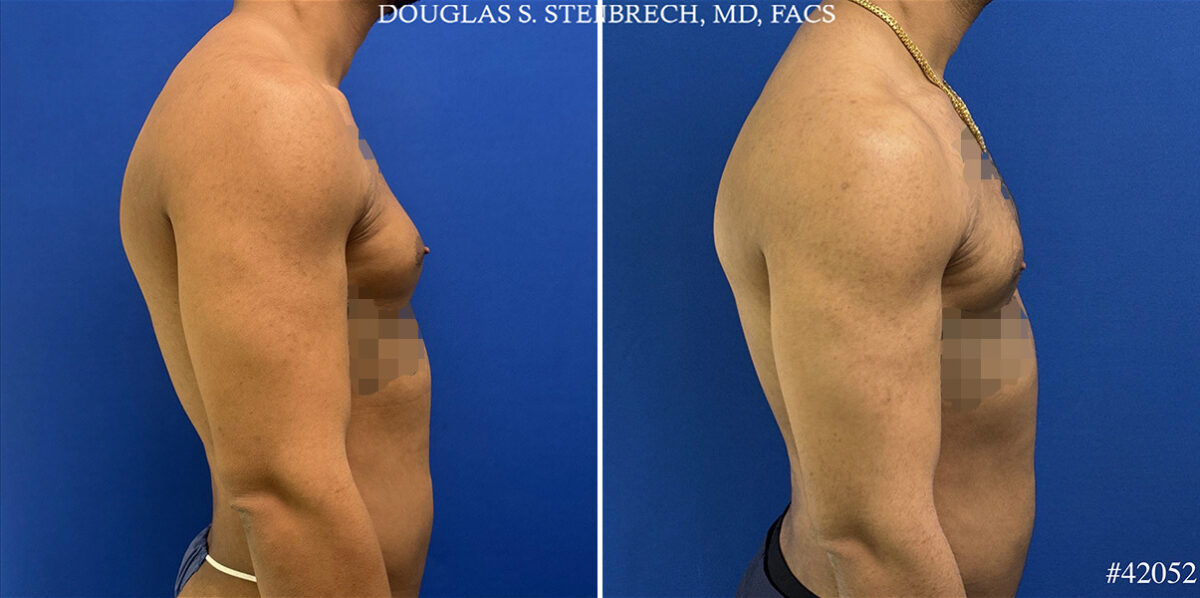 Gynecomastia Before and After Photos in CA, Beverly Hills, Patient 25745