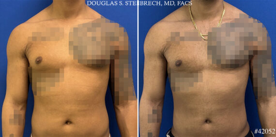 Gynecomastia Before and After Photos in CA, Beverly Hills, Patient 25745