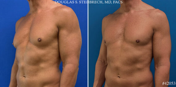 Gynecomastia Before and After Photos in CA, Beverly Hills, Patient 25761