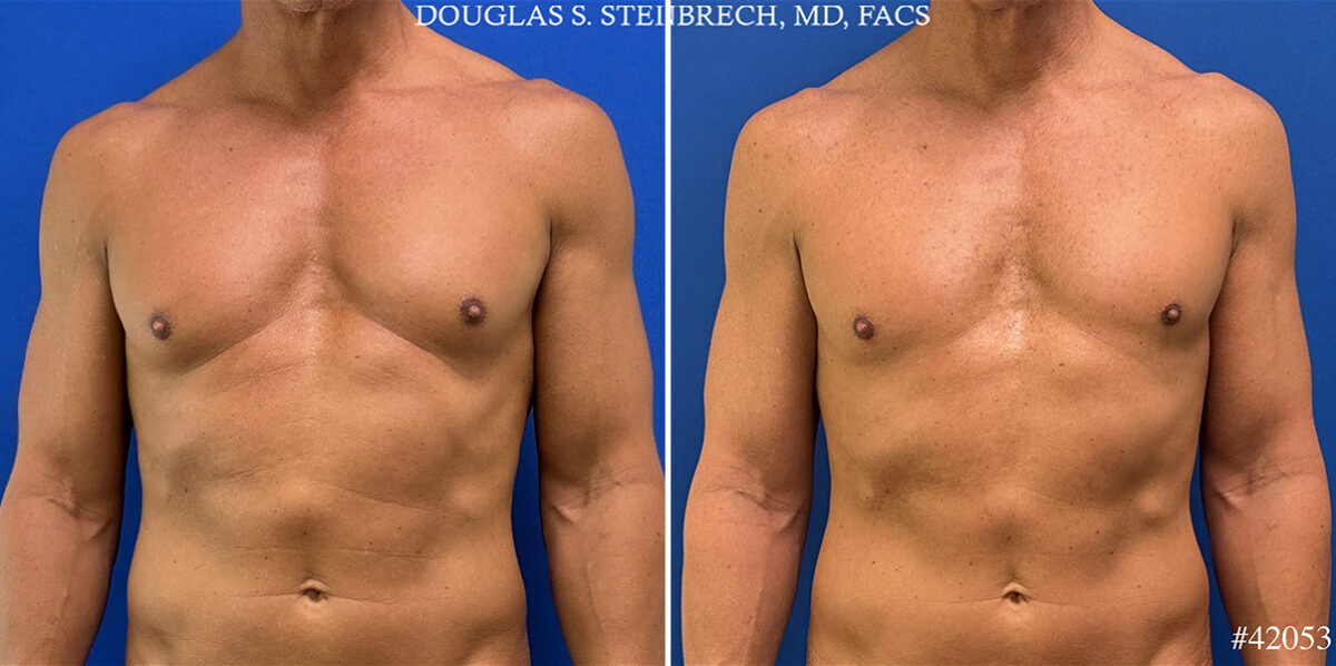 Gynecomastia Before and After Photos in CA, Beverly Hills, Patient 25761