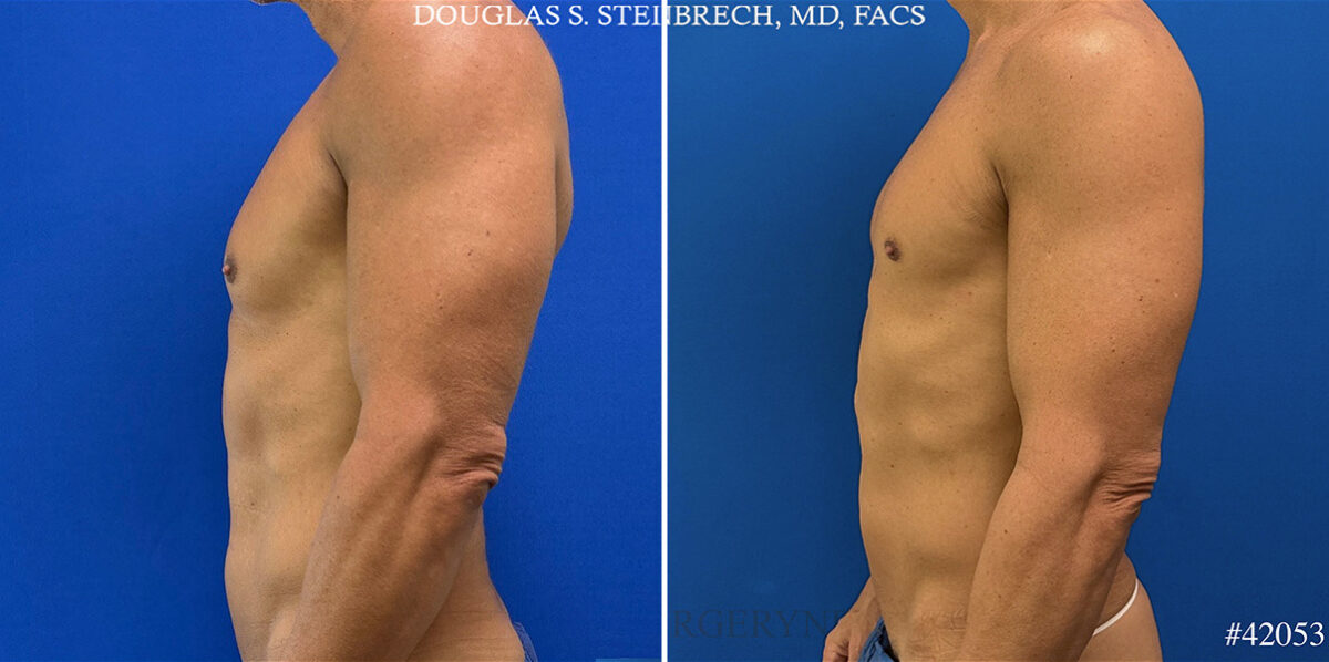 Gynecomastia Before and After Photos in CA, Beverly Hills, Patient 25761