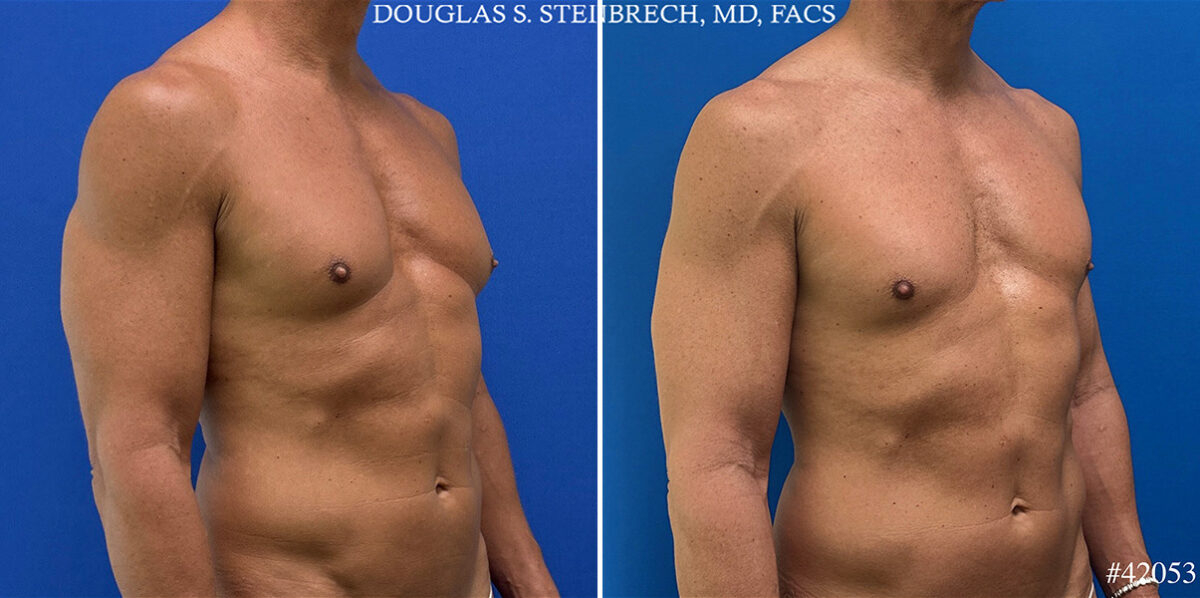 Gynecomastia Before and After Photos in CA, Beverly Hills, Patient 25761